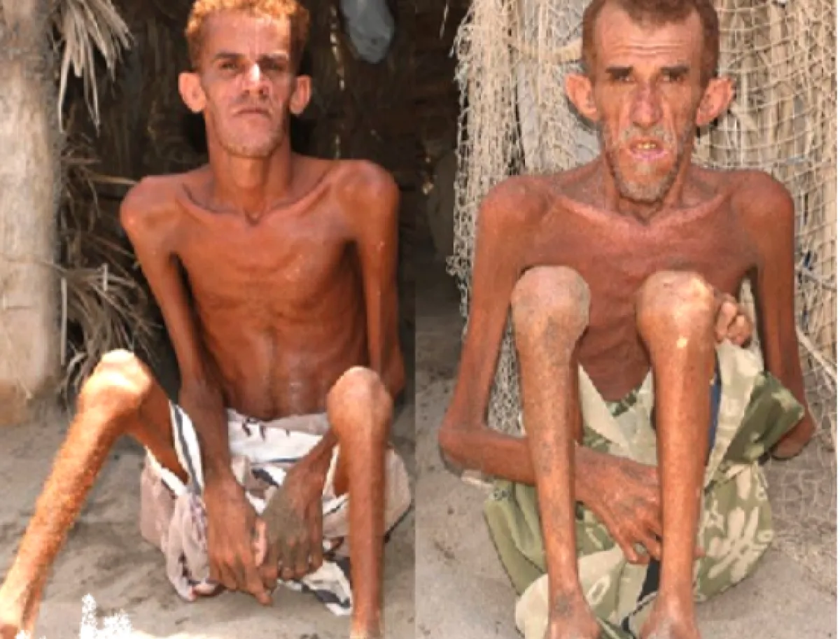 الفاو: اليمن بين أسوأ 5 أزمات غذائية عالمياً