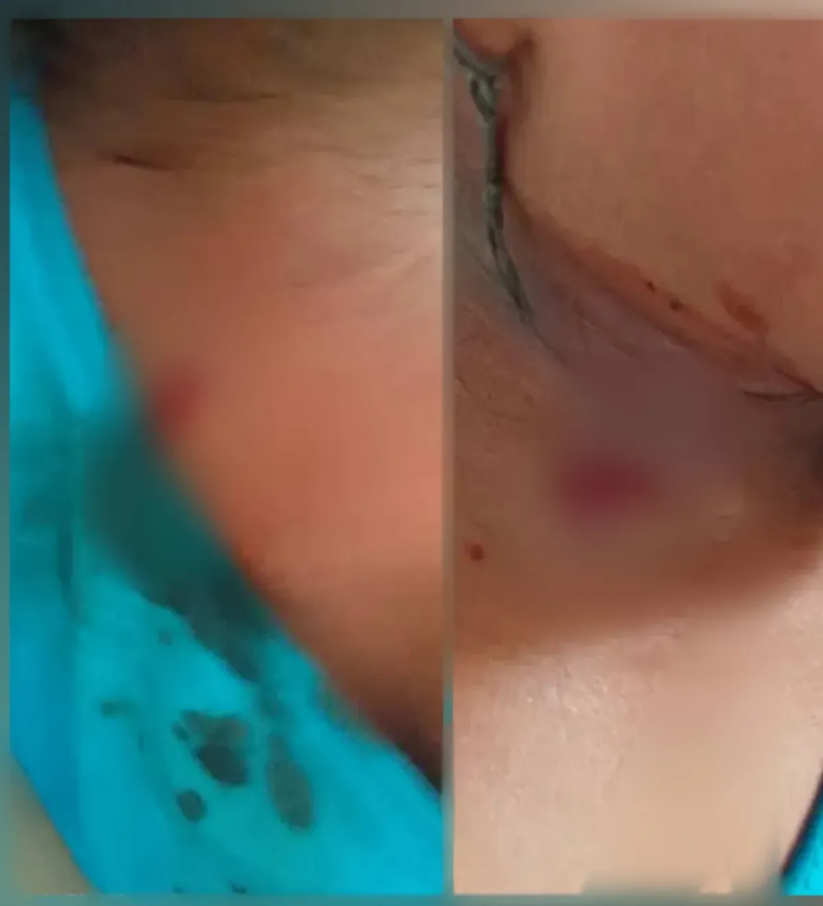 إصابة طفلة برصاص قناصة مليشيا الحوثي الإرهابية في مقبنة غرب تعز